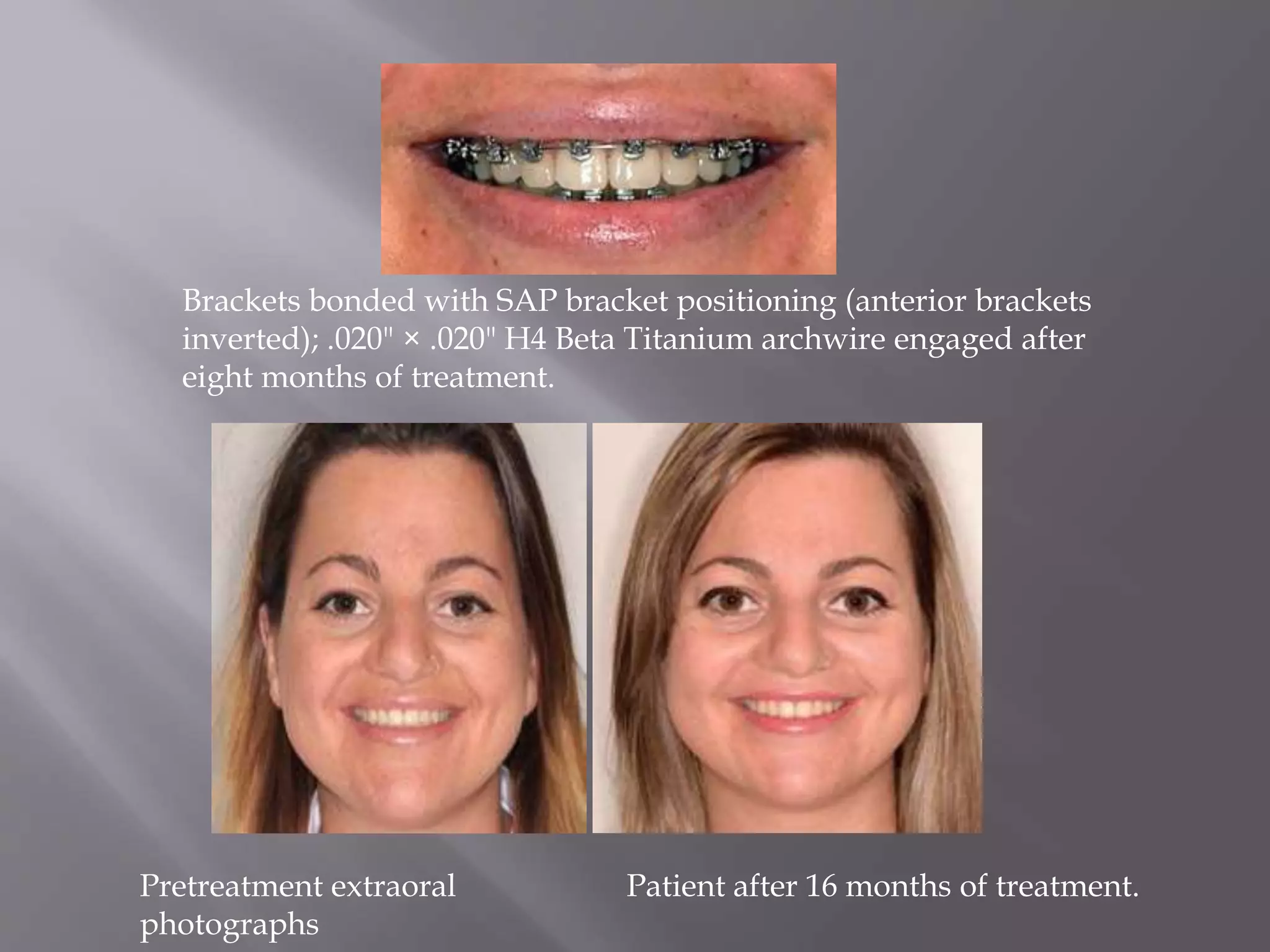 Brackets bonded with SAP bracket positioning (anterior brackets
inverted); .020" × .020" H4 Beta Titanium archwire engaged after
eight months of treatment.
Patient after 16 months of treatment.Pretreatment extraoral
photographs
 