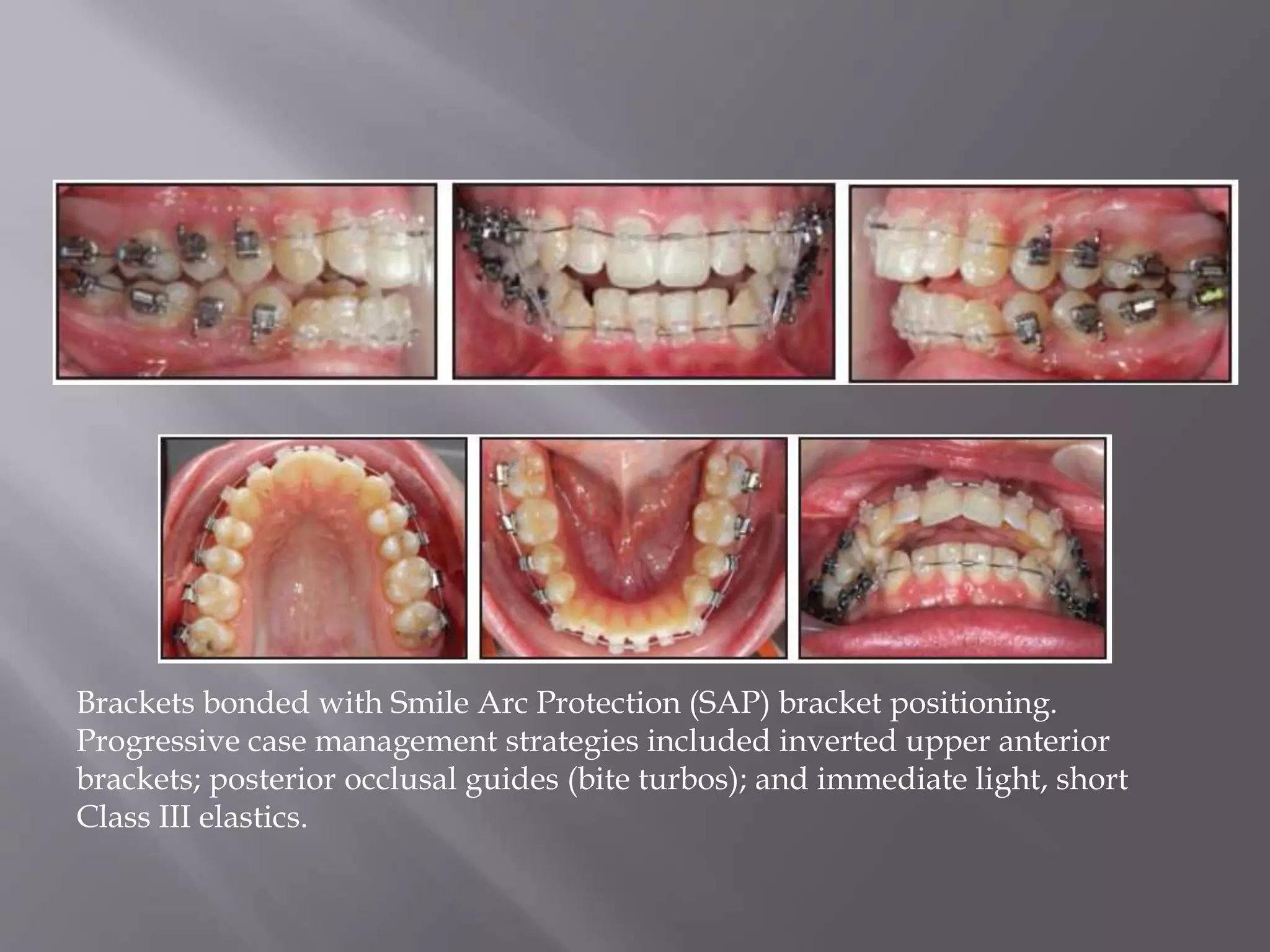 Brackets bonded with Smile Arc Protection (SAP) bracket positioning.
Progressive case management strategies included inverted upper anterior
brackets; posterior occlusal guides (bite turbos); and immediate light, short
Class III elastics.
 