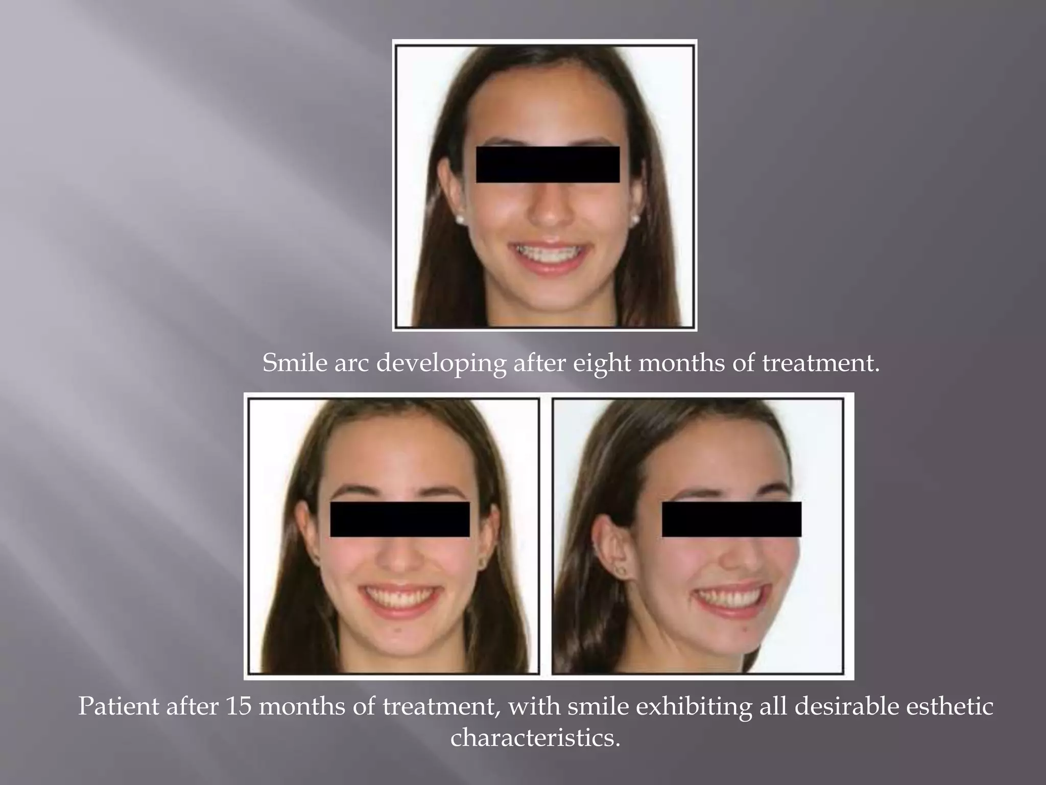 Smile arc developing after eight months of treatment.
Patient after 15 months of treatment, with smile exhibiting all desirable esthetic
characteristics.
 