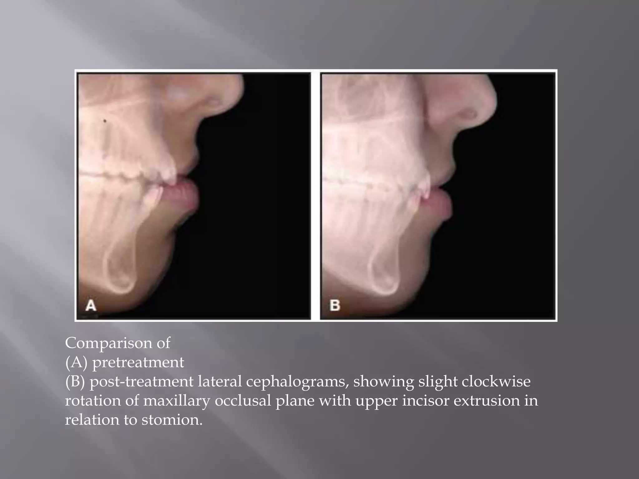 Comparison of
(A) pretreatment
(B) post-treatment lateral cephalograms, showing slight clockwise
rotation of maxillary occlusal plane with upper incisor extrusion in
relation to stomion.
 
