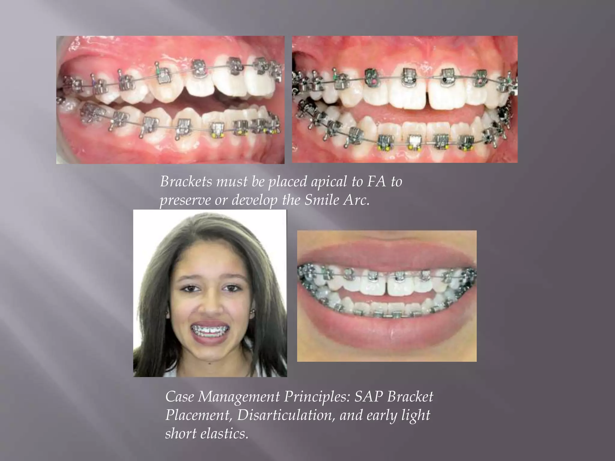 Brackets must be placed apical to FA to
preserve or develop the Smile Arc.
Case Management Principles: SAP Bracket
Placement, Disarticulation, and early light
short elastics.
 