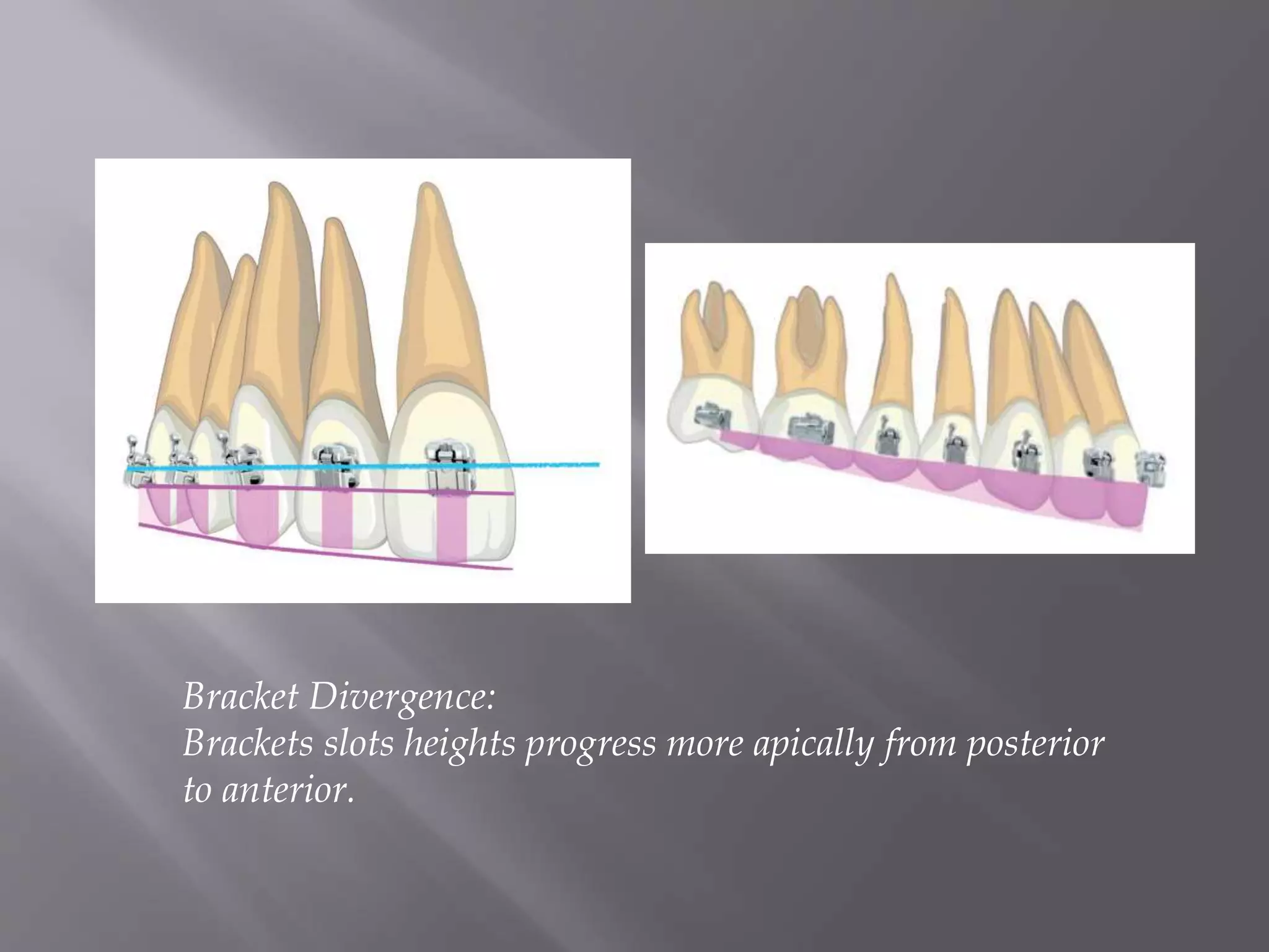 Bracket Divergence:
Brackets slots heights progress more apically from posterior
to anterior.
 