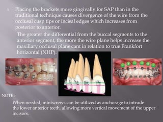 3. Placing the brackets more gingivally for SAP than in the
traditional technique causes divergence of the wire from the
occlusal cusp tips or incisal edges which increases from
posterior to anterior.
The greater the differential from the buccal segments to the
anterior segment, the more the wire plane helps increase the
maxillary occlusal plane cant in relation to true Frankfort
horizontal (NHP).
When needed, miniscrews can be utilized as anchorage to intrude
the lower anterior teeth, allowing more vertical movement of the upper
incisors.
NOTE :
 