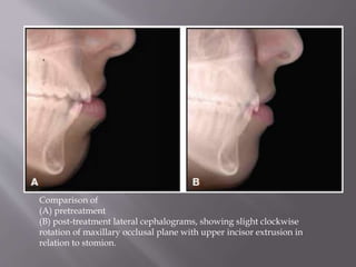 Comparison of
(A) pretreatment
(B) post-treatment lateral cephalograms, showing slight clockwise
rotation of maxillary occlusal plane with upper incisor extrusion in
relation to stomion.
 