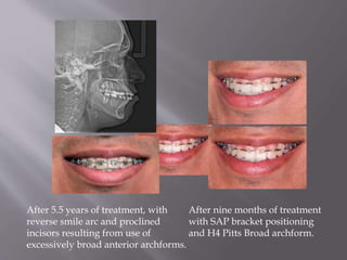 After nine months of treatment
with SAP bracket positioning
and H4 Pitts Broad archform.
After 5.5 years of treatment, with
reverse smile arc and proclined
incisors resulting from use of
excessively broad anterior archforms.
 
