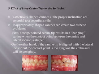 5. Effect of Steep Canine Tips on the Smile Arc:
 Esthetically shaped canines at the proper inclination are
essential to a beautiful smile.
 Inappropriately shaped canines can create two esthetic
problems:
- First, a steep, pointed canine tip results in a “hanging”
canine when the contact point between the canine and
lateral incisor is aligned.
-On the other hand, if the canine tip is aligned with the lateral
incisor but the contact point is too gingival, the embrasure
will be unsightly.
A B
 