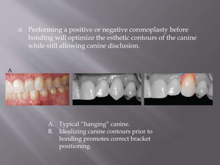 Performing a positive or negative coronoplasty before
bonding will optimize the esthetic contours of the canine
while still allowing canine disclusion.
A. Typical “hanging” canine.
B. Idealizing canine contours prior to
bonding promotes correct bracket
positioning.
A B
A
 