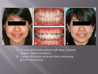 A. 11-year-old female patient with steep, pointed
canines before treatment.
B. Canine disclusion achieved after contouring
prior to bracketing.
 