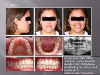  Case1:
21-year-old female patient
with hypertrophic masseter
muscles, Class III tendency,
proclined upper incisors, and
reverse curve
smile arc before treatment.
 
