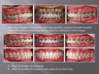 After nine months of treatment, showing maxillary anterior brackets bonded
with SAP bracket positioning and inverted for additional crown torque
(circled numbers).
A. After 12 months of treatment.
B. After 15 months of treatment and gingival recontouring.
 