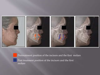 Pretreatment position of the incisors and the first molars
Post treatment position of the incisors and the first
molars
 