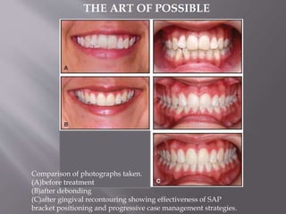 Comparison of photographs taken.
(A)before treatment
(B)after debonding
(C)after gingival recontouring showing effectiveness of SAP
bracket positioning and progressive case management strategies.
THE ART OF POSSIBLE
 