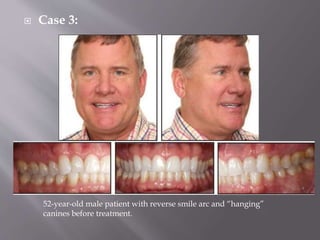  Case 3:
52-year-old male patient with reverse smile arc and “hanging”
canines before treatment.
 