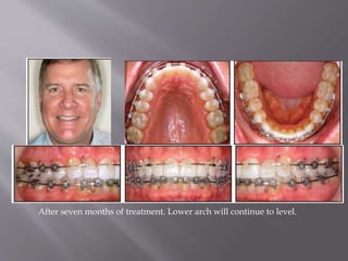 After seven months of treatment. Lower arch will continue to level.
 