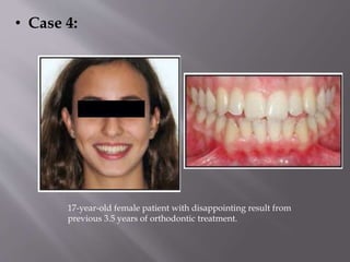 17-year-old female patient with disappointing result from
previous 3.5 years of orthodontic treatment.
• Case 4:
 