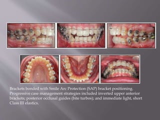 Brackets bonded with Smile Arc Protection (SAP) bracket positioning.
Progressive case management strategies included inverted upper anterior
brackets; posterior occlusal guides (bite turbos); and immediate light, short
Class III elastics.
 