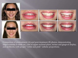 Comparison of pretreatment (A) and post-treatment (B) photos, demonstrating
improvements in smile arc, cant of upper occlusal plane, incisor and gingival display,
and archform, with proper “white and pink” esthetic proportions.
 