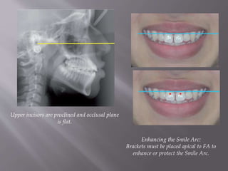 Upper incisors are proclined and occlusal plane
is flat.
Enhancing the Smile Arc:
Brackets must be placed apical to FA to
enhance or protect the Smile Arc.
 