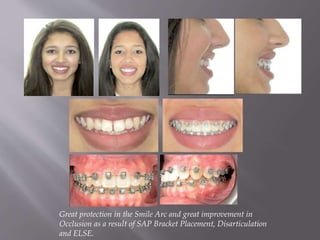 Great protection in the Smile Arc and great improvement in
Occlusion as a result of SAP Bracket Placement, Disarticulation
and ELSE.
 