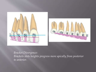 Bracket Divergence:
Brackets slots heights progress more apically from posterior
to anterior.
 