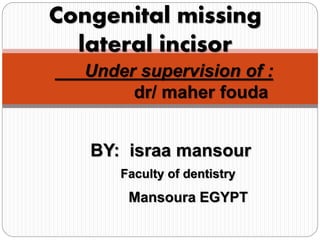 BY: israa mansour
Under supervision of :
dr/ maher fouda
Congenital missing
lateral incisor
Faculty of dentistry
Mansoura EGYPT
 
