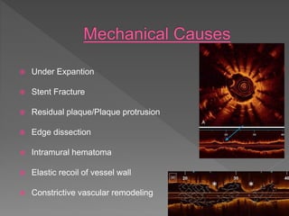  Under Expantion
 Stent Fracture
 Residual plaque/Plaque protrusion
 Edge dissection
 Intramural hematoma
 Elastic recoil of vessel wall
 Constrictive vascular remodeling
 