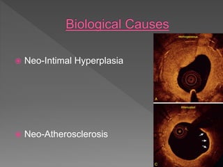 Neo-Intimal Hyperplasia
 Neo-Atherosclerosis
 