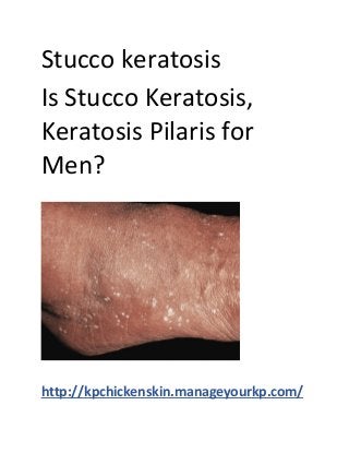 Stucco keratosis
Is Stucco Keratosis,
Keratosis Pilaris for
Men?
http://kpchickenskin.manageyourkp.com/
 