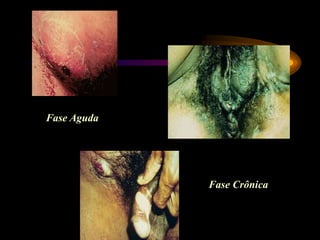 Fase Aguda
Fase Crônica
 