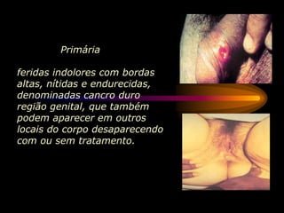 Primária
feridas indolores com bordas
altas, nítidas e endurecidas,
denominadas cancro duro
região genital, que também
podem aparecer em outros
locais do corpo desaparecendo
com ou sem tratamento.
 