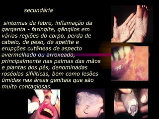 secundária
sintomas de febre, inflamação da
garganta - faringite, gânglios em
várias regiões do corpo, perda de
cabelo, de peso, de apetite e
erupções cutâneas de aspecto
avermelhado ou arroxeado,
principalmente nas palmas das mãos
e plantas dos pés, denominadas
roséolas sifilíticas, bem como lesões
úmidas nas áreas genitais que são
muito contagiosas.
 