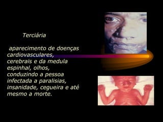Terciária
aparecimento de doenças
cardiovasculares,
cerebrais e da medula
espinhal, olhos,
conduzindo a pessoa
infectada a paralisias,
insanidade, cegueira e até
mesmo a morte.
 