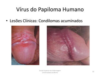 Vírus do Papiloma Humano
• Lesões Clínicas: Condilomas acuminados




                 Escola Superior de Enfermagem
                                                 10
                     Universidade do Minho
 