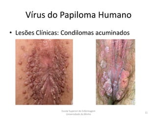 Vírus do Papiloma Humano
• Lesões Clínicas: Condilomas acuminados




                 Escola Superior de Enfermagem
                                                 11
                     Universidade do Minho
 