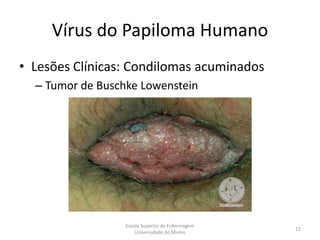 Vírus do Papiloma Humano
• Lesões Clínicas: Condilomas acuminados
  – Tumor de Buschke Lowenstein




                  Escola Superior de Enfermagem
                                                  12
                      Universidade do Minho
 