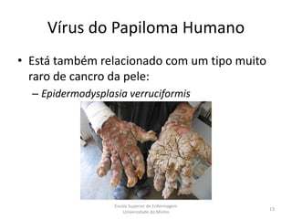 Vírus do Papiloma Humano
• Está também relacionado com um tipo muito
  raro de cancro da pele:
  – Epidermodysplasia verruciformis




                   Escola Superior de Enfermagem
                                                   13
                       Universidade do Minho
 