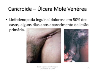 Cancroide – Úlcera Mole Venérea
• Linfodenopatia inguinal dolorosa em 50% dos
  casos, alguns dias após aparecimento da lesão
  primária.




                 Escola Superior de Enfermagem
                                                 24
                     Universidade do Minho
 