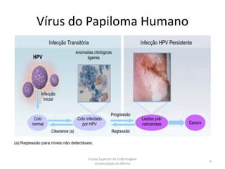 Vírus do Papiloma Humano




        Escola Superior de Enfermagem
                                        6
            Universidade do Minho
 