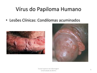 Vírus do Papiloma Humano
• Lesões Clínicas: Condilomas acuminados




                 Escola Superior de Enfermagem
                                                 9
                     Universidade do Minho
 