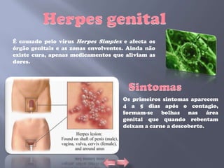 É causado pelo vírus Herpes Simplex e afecta os
órgão genitais e as zonas envolventes. Ainda não
existe cura, apenas medicamentos que aliviam as
dores.




                                     Os primeiros sintomas aparecem
                                     4 a 5 dias após o contagio,
                                     formam-se bolhas nas área
                                     genital que quando rebentam
                                     deixam a carne a descoberto.
 