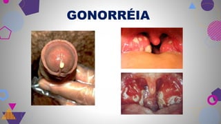 GONORRÉIA
 