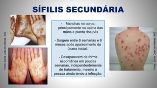 SÍFILIS SECUNDÁRIA
- Manchas no corpo,
principalmente na palma das
mãos e planta dos pés
- Surgem entre 6 semanas e 6
meses após aparecimento da
úlcera inicial.
- Desaparecem de forma
espontânea em poucas
semanas, independentemente
de tratamento, mesmo a
pessoa ainda tendo a infecção.
Fonte:SantaCasadeAlfenas-MG
Fonte:SantaCasadeAlfenas-MG
 