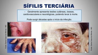 SÍFILIS TERCIÁRIA
- Geralmente apresenta lesões cutâneas, ósseas,
cardiovasculares e neurológicas, podendo levar à morte.
Pode surgir décadas após o início da infecção.
Fonte:SantaCasadeAlfenas-MG
Fonte:SantaCasadeAlfenas-MG
 