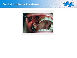 Dental implants treatment
 