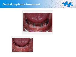 Dental implants treatment
 