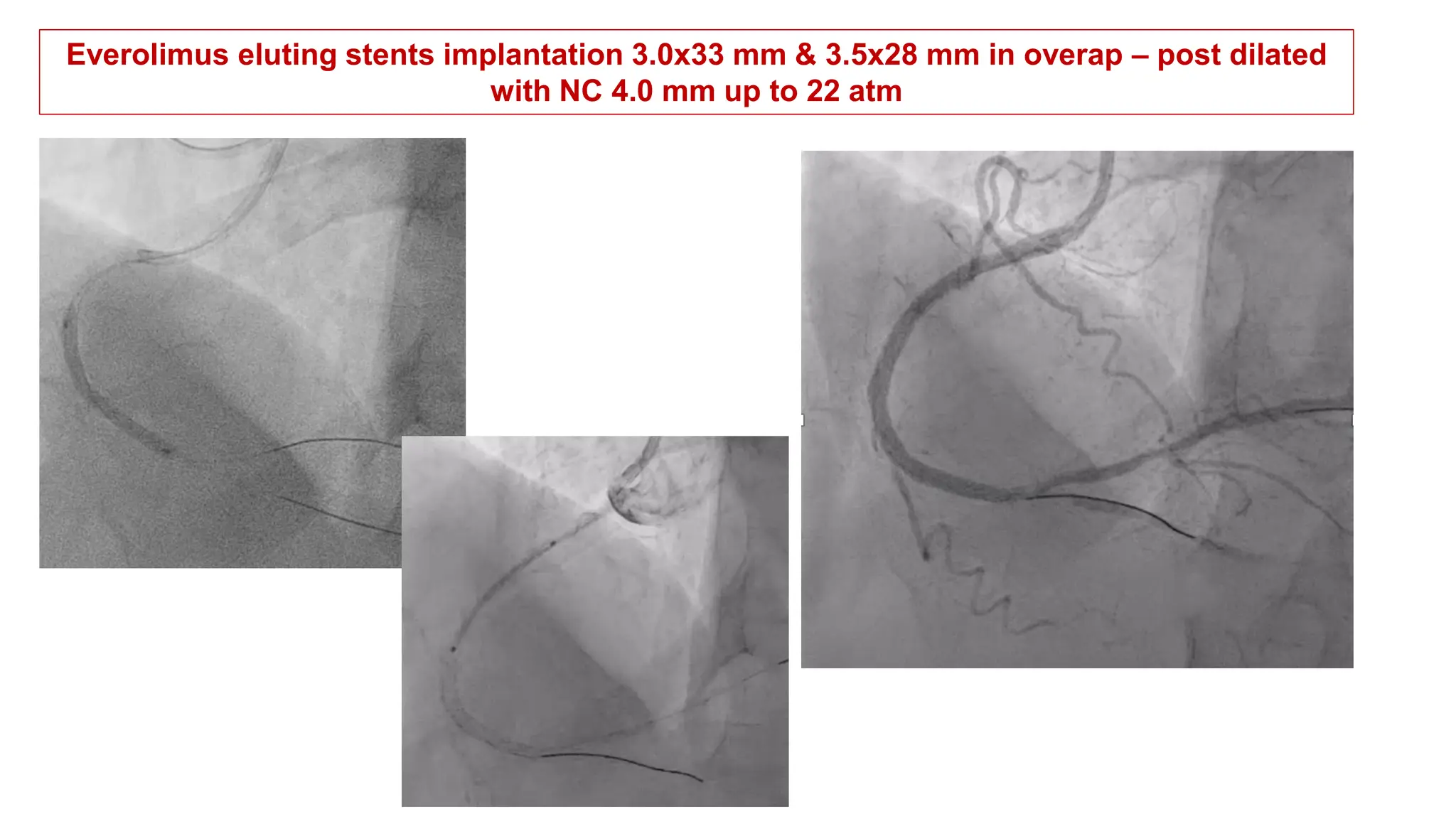 Everolimus eluting stents implantation 3.0x33 mm & 3.5x28 mm in overap – post dilated
with NC 4.0 mm up to 22 atm
 