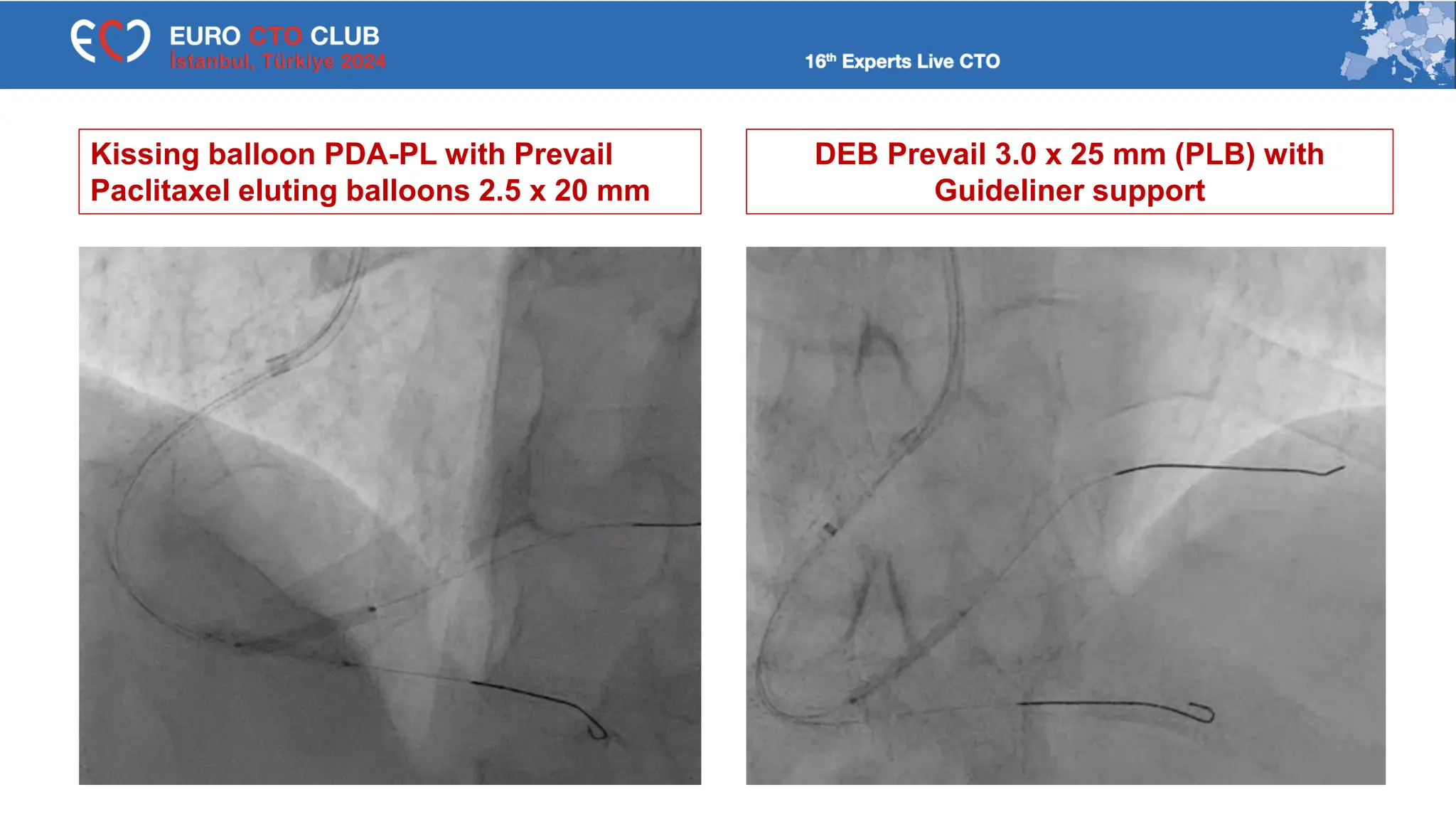 Kissing balloon PDA-PL with Prevail
Paclitaxel eluting balloons 2.5 x 20 mm
DEB Prevail 3.0 x 25 mm (PLB) with
Guideliner support
 