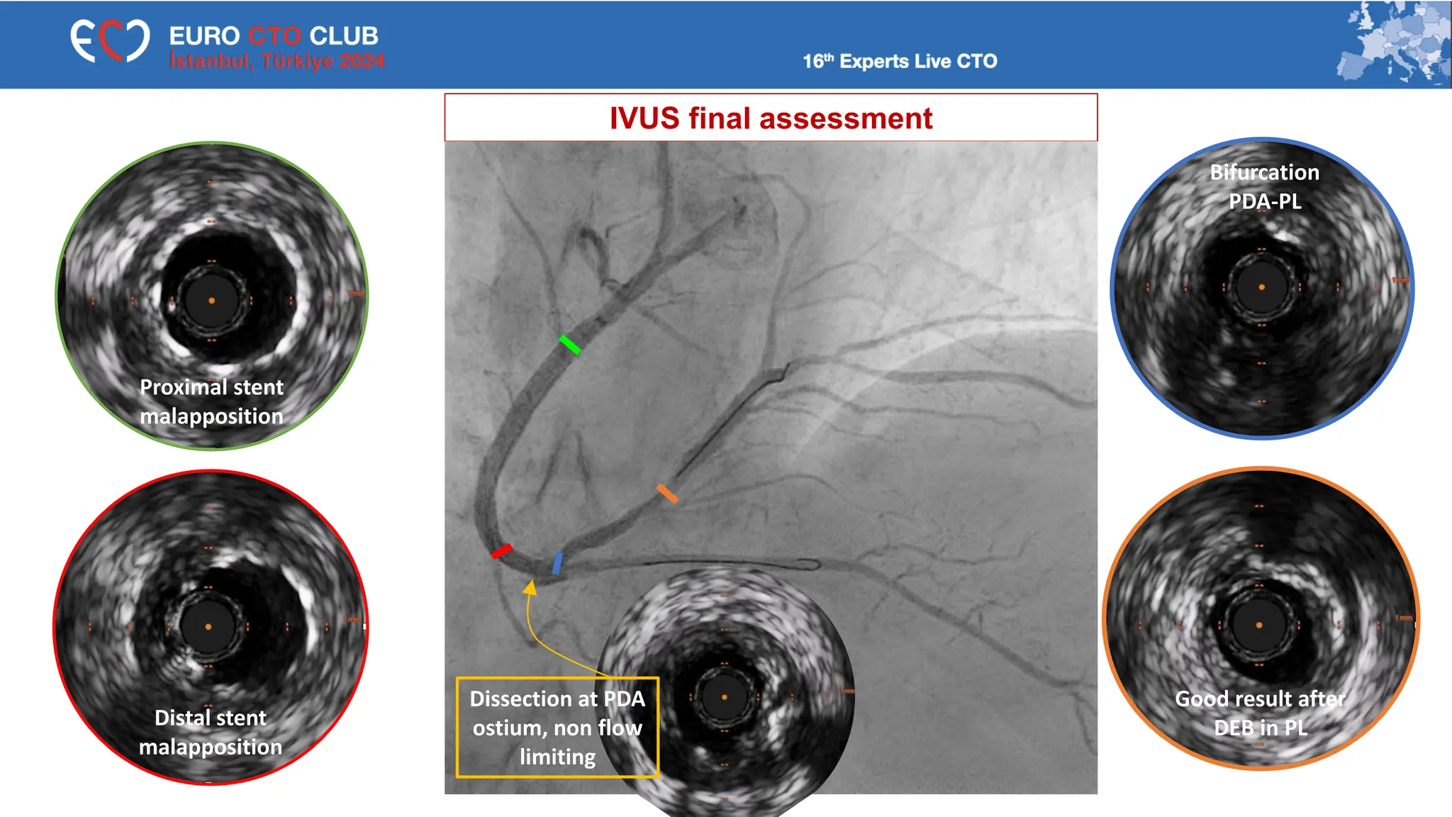 IVUS final assessment
Good result after
DEB in PL
Bifurcation
PDA-PL
Distal stent
malapposition
Dissection at PDA
ostium, non flow
limiting
Proximal stent
malapposition
 
