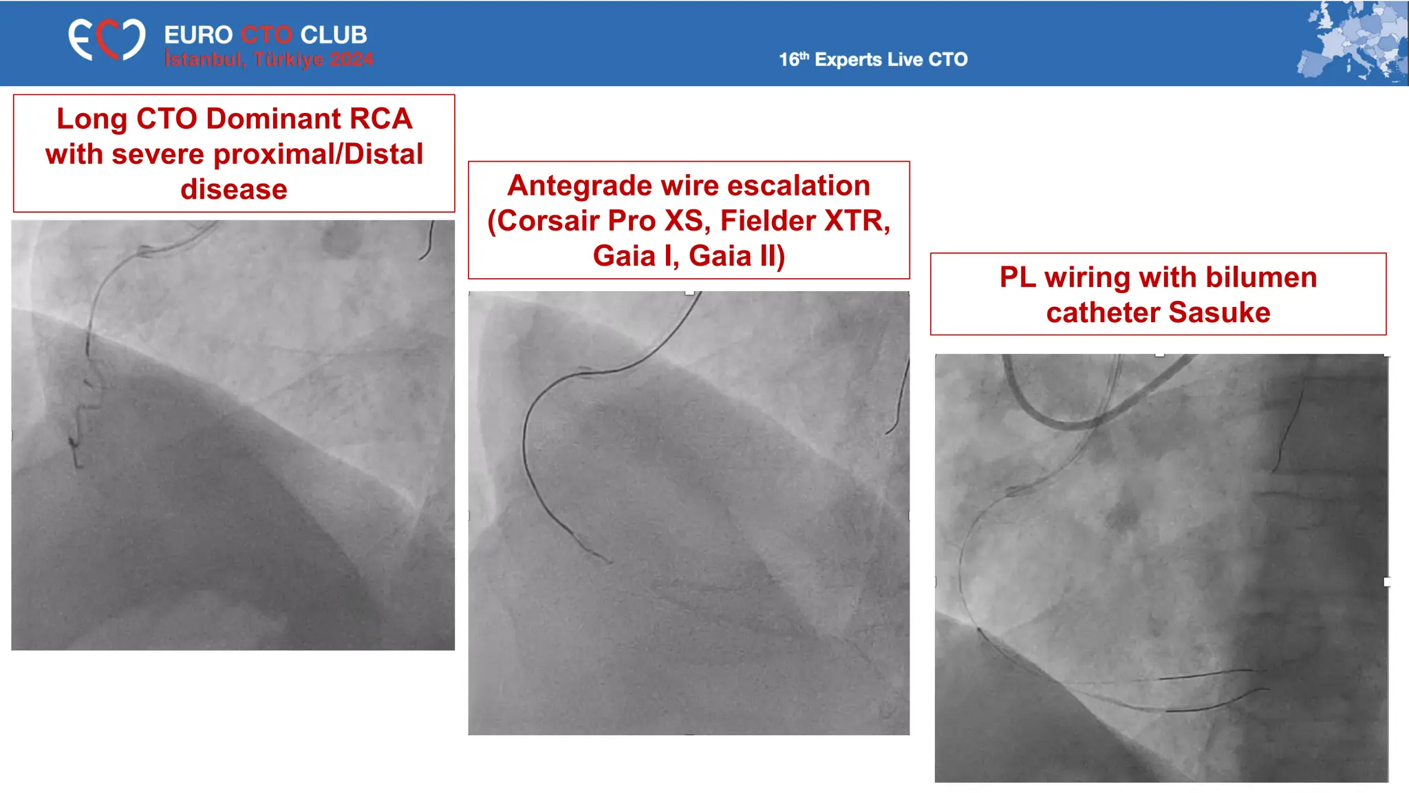Antegrade wire escalation
(Corsair Pro XS, Fielder XTR,
Gaia I, Gaia II)
PL wiring with bilumen
catheter Sasuke
Long CTO Dominant RCA
with severe proximal/Distal
disease
 