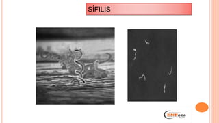SÍFILIS
 
